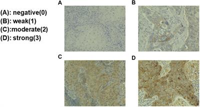 GPNMB-Positive Cells in Head and Neck Squamous Cell Carcinoma—Their Roles in Cancer Stemness, Therapy Resistance, and Metastasis